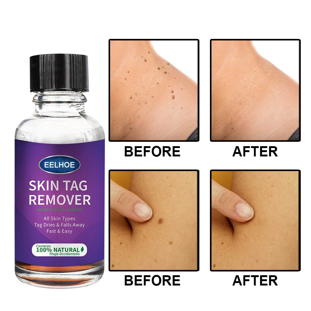 Eelhoe Skin Verrucous Remover