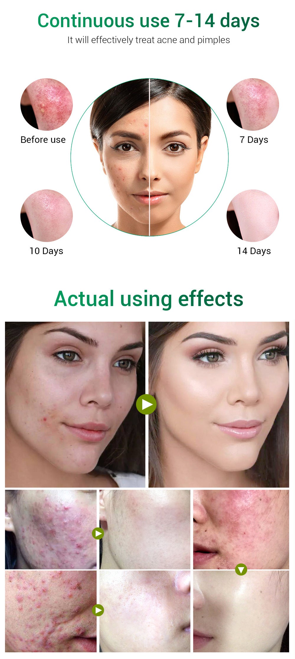 BREYLEE Tea Tree Acne Cream