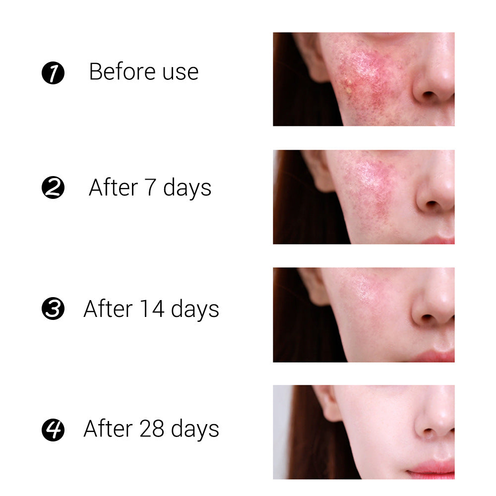BREYLEE Tea Tree Acne Cream