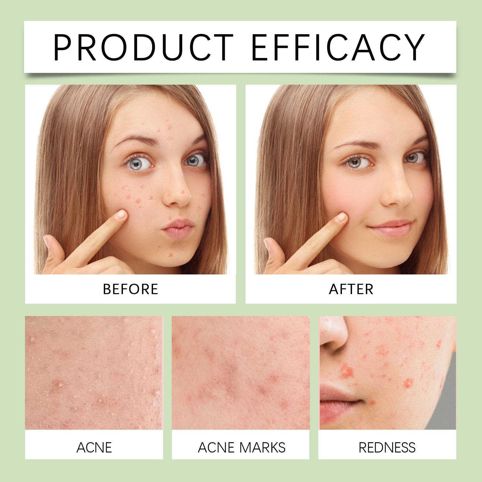 Acne Miracle Patch Removes P